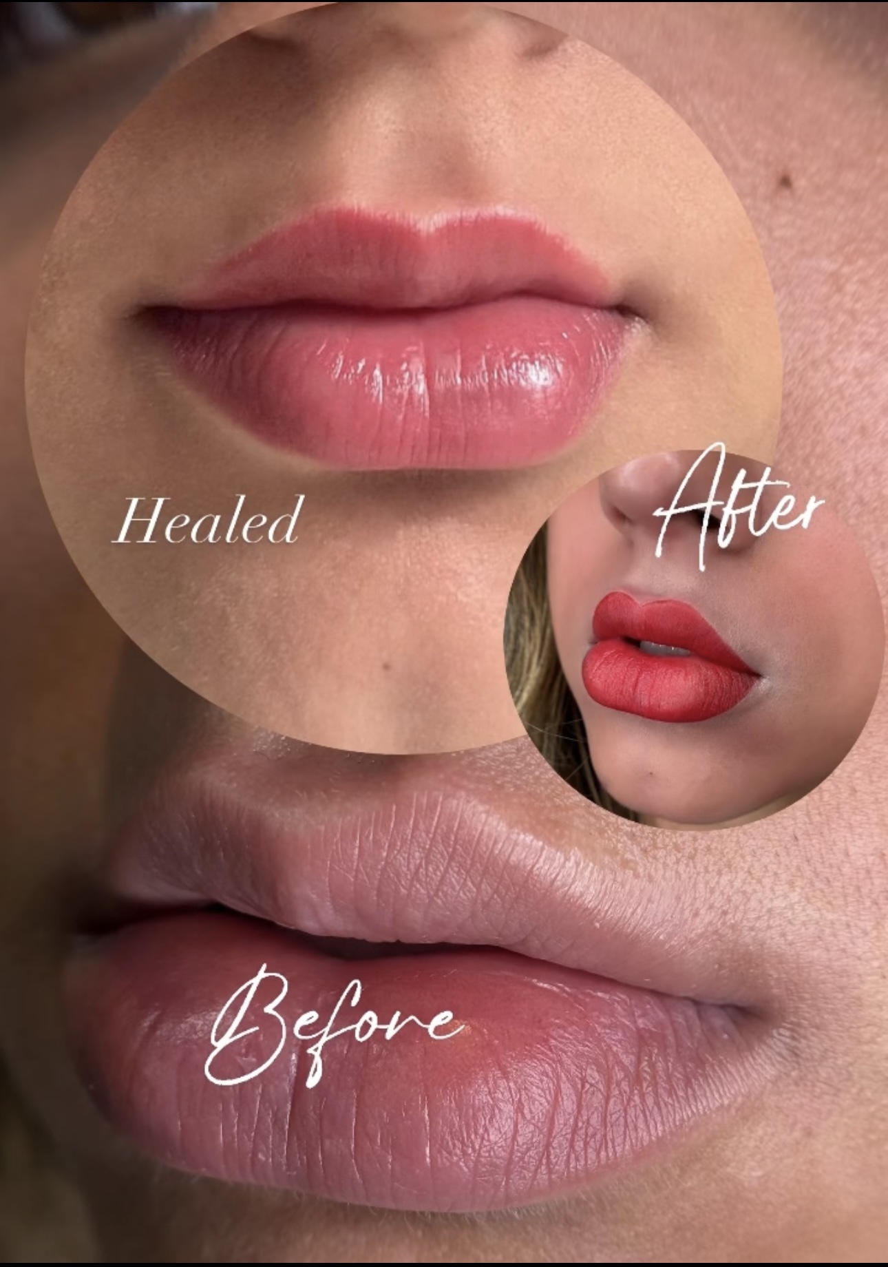 Step 3: Treatment finishing (20 min)